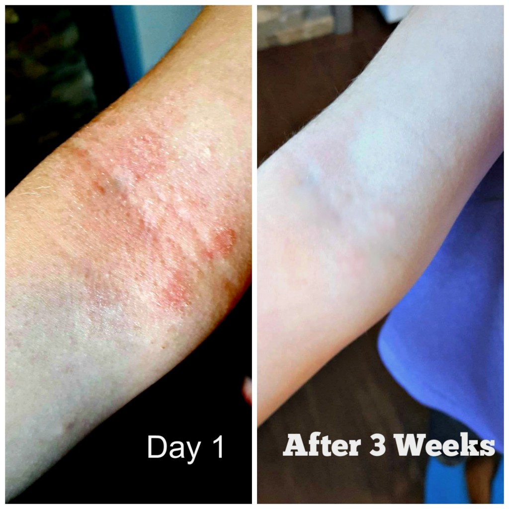 Baby Girls Arms Before and After Using Nutropic